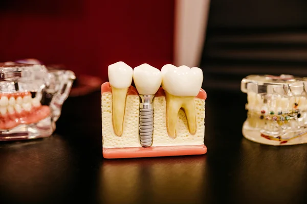 Un modèle d'implant dentaire avec trois dents et une base métallique, à côté d'autres modèles dentaires.