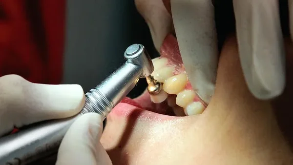Un dentiste soignant les dents d'un patient à l'aide d'une fraise dentaire.